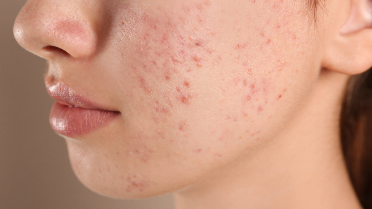 What can you do about the red marks leftover from breakouts?